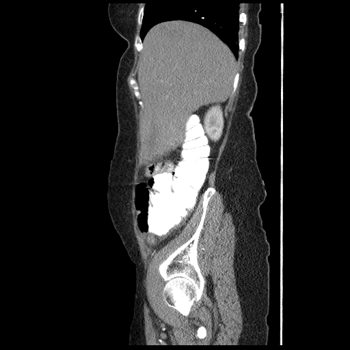 File:Acute appendicitis (Radiopaedia 52672-58589 Sagittal C+ arterial phase 20).jpg