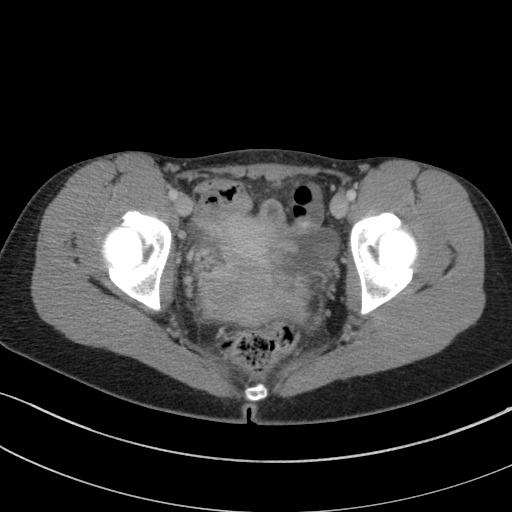 Acute appendicitis (Radiopaedia 62608-70901 Axial C+ portal venous phase 48).jpg
