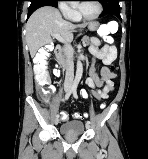 File:Acute appendicitis (Radiopaedia 77016-88960 Coronal C+ portal venous phase 49).jpg