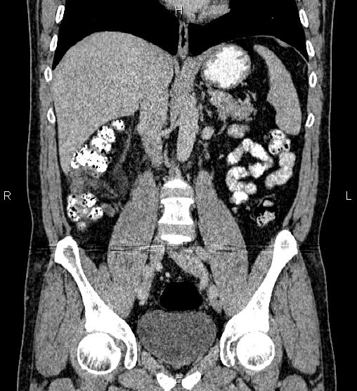 Acute appendicitis (Radiopaedia 84780-100240 Coronal C+ portal venous phase 44).jpg
