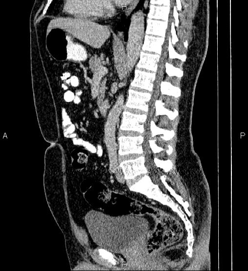 Acute appendicitis (Radiopaedia 84780-100240 Sagittal C+ portal venous phase 53).jpg