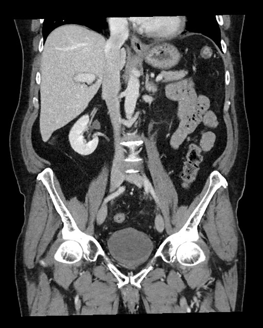 Acute appendicitis - large appendicoliths (Radiopaedia 61805-69820 Coronal C+ portal venous phase 70).jpg