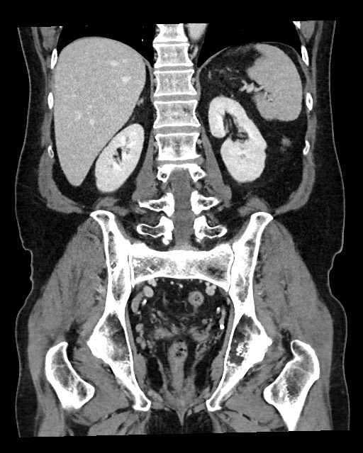 Acute appendicitis - large appendicoliths (Radiopaedia 61805-69820 Coronal C+ portal venous phase 92).jpg