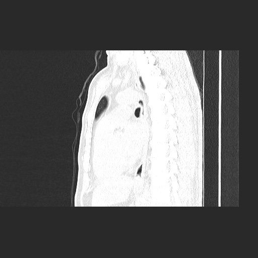 Acute appendicitis and COVID 19 pneumonia (Radiopaedia 76604-88380 Sagittal lung window 53).jpg