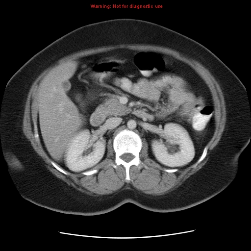 Acute appendicitis complicated by ovarian vein thrombophlebitis (Radiopaedia 16172-15851 Axial C+ portal venous phase 38).jpg