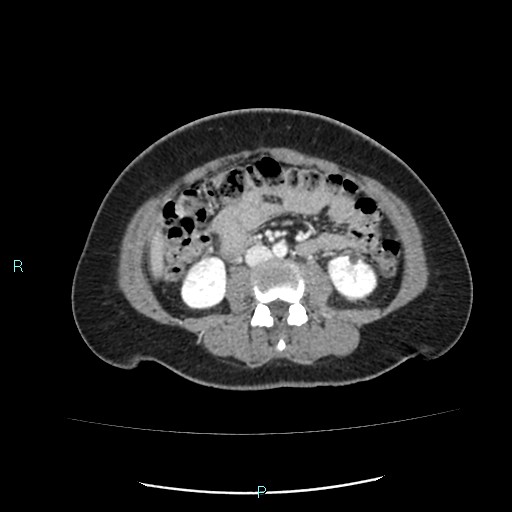 Acute bilateral pyelonephritis (Radiopaedia 37146-38881 Axial C+ portal venous phase 55).jpg