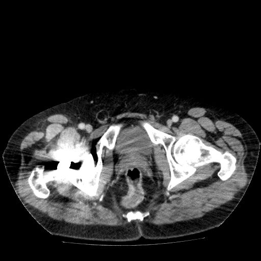File:Acute cholecystitis and incidental left sided IVC (Radiopaedia 49352-54459 Axial C+ portal venous phase 152).jpg