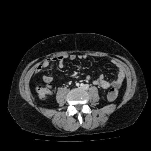 Acute cholecystitis and incidental left sided IVC (Radiopaedia 49352-54459 Axial C+ portal venous phase 93).jpg