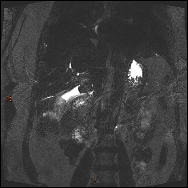 File:Acute cholecystitis with gallbladder neck calculus (Radiopaedia 42795-45971 Coronal Turbo spin echo 13).jpg