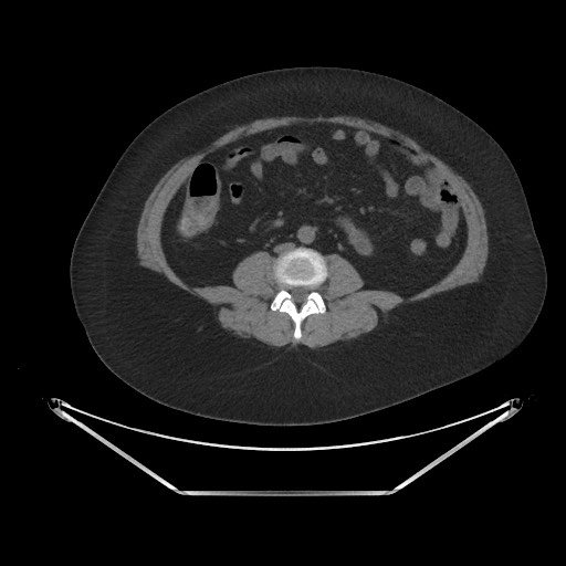 Acute cholecystitis with tensile fundus sign (Radiopaedia 71394-81723 Axial non-contrast 59).jpg