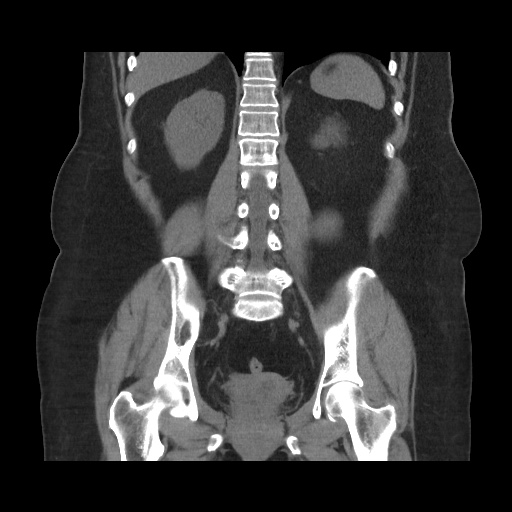 File:Acute cholecystitis with tensile fundus sign (Radiopaedia 71394-81723 Coronal 10).jpg