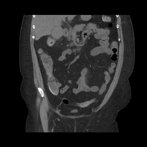File:Acute cholecystitis with tensile fundus sign (Radiopaedia 71394-81723 Coronal non-contrast 56).jpg