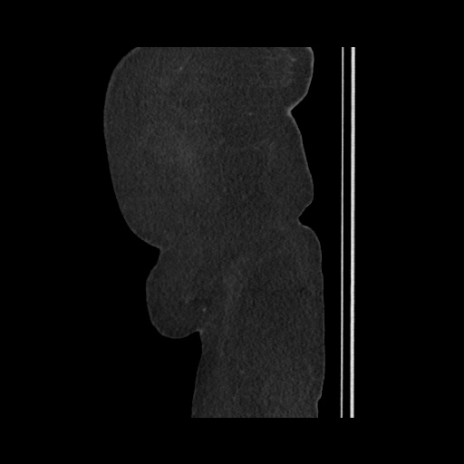 Acute cholecystitis with tensile fundus sign (Radiopaedia 71394-81723 Sagittal non-contrast 158).jpg