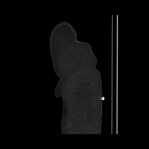 Acute cholecystitis with tensile fundus sign (Radiopaedia 71394-81723 Sagittal non-contrast 19).jpg