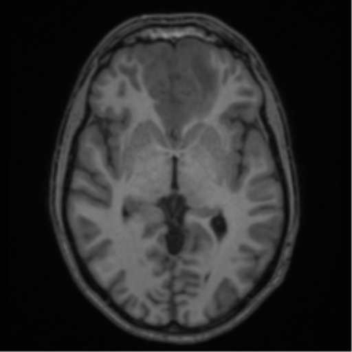 Acute disseminated encephalomyelitis (ADEM) (Radiopaedia 65319-74349 Axial T1 30).png