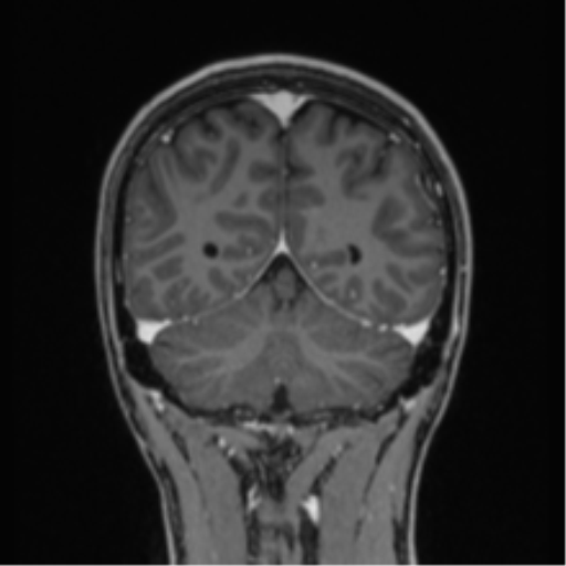 File:Acute disseminated encephalomyelitis (ADEM) (Radiopaedia 65319-74349 Coronal T1 C+ 1).png