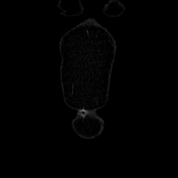 Acute diverticulitis (Radiopaedia 34183-35442 Coronal C+ portal venous phase 3).jpg