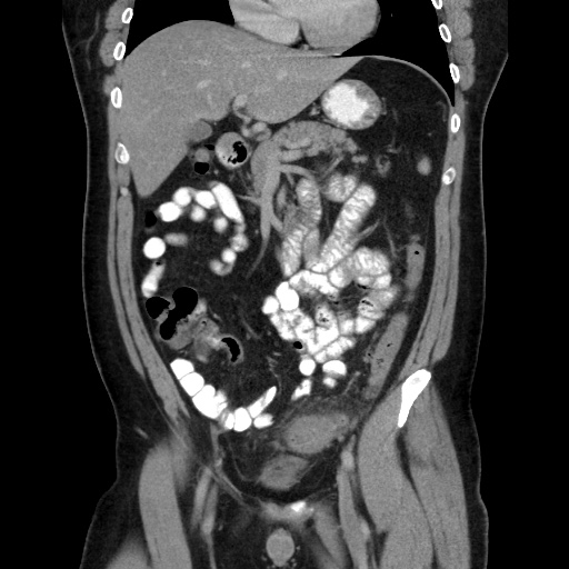 Acute diverticulitis with localized perforation (Radiopaedia 41296-44113 Coronal C+ portal venous phase 28).jpg