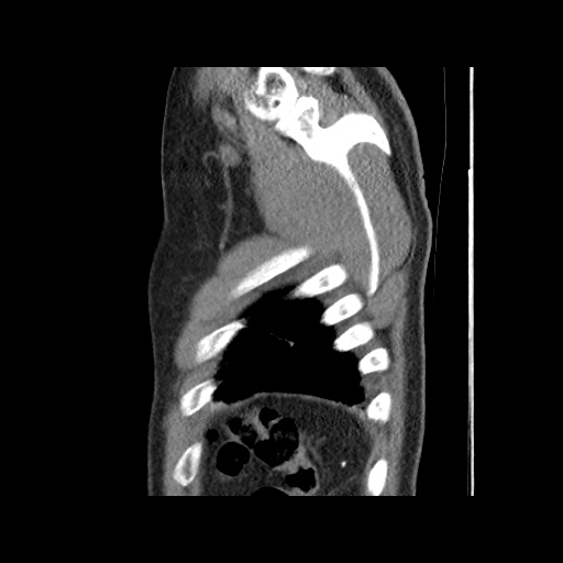 Acute epicardial fat necrosis (Radiopaedia 42327-45440 Sagittal C+ CTPA 64).jpg