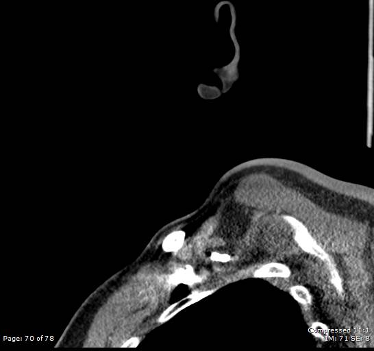 Acute epiglottitis (Radiopaedia 54375-60590 Sagittal C+ arterial phase 70).jpg