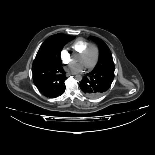 Acute heart failure (CT) (Radiopaedia 79835-93075 Axial C+ arterial phase 24).jpg