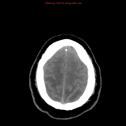 Acute hemorrhagic leukoencephalitis (Radiopaedia 14076-13920 Axial non-contrast 43).jpg