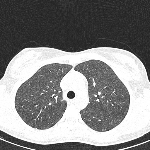 File:Acute hypersensitivity pneumonitis (Radiopaedia 85293-100870 Axial lung window 34).jpg