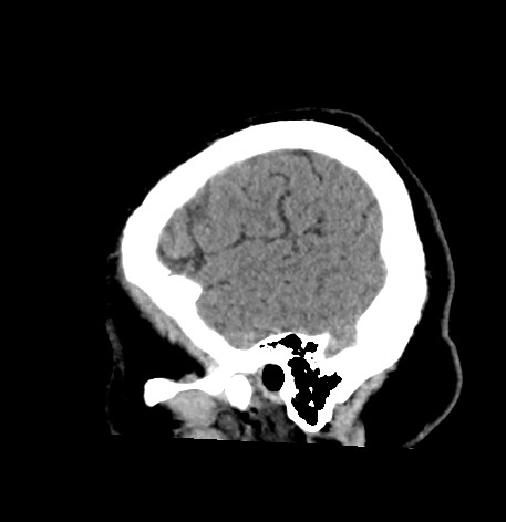 Acute internal carotid artery dissection (Radiopaedia 53541-59558 Sagittal non-contrast 55).jpg