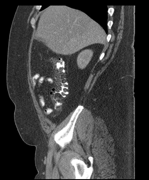 Acute mesenteric venous ischemia (Radiopaedia 46041-50383 Sagittal C+ portal venous phase 24).jpg