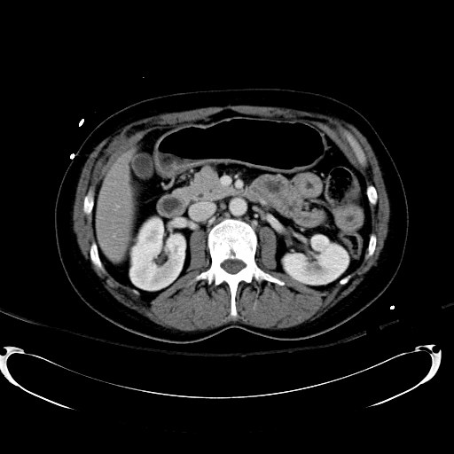 Acute myocardial infarction in CT (Radiopaedia 39947-42415 Axial C+ portal venous phase 51).jpg
