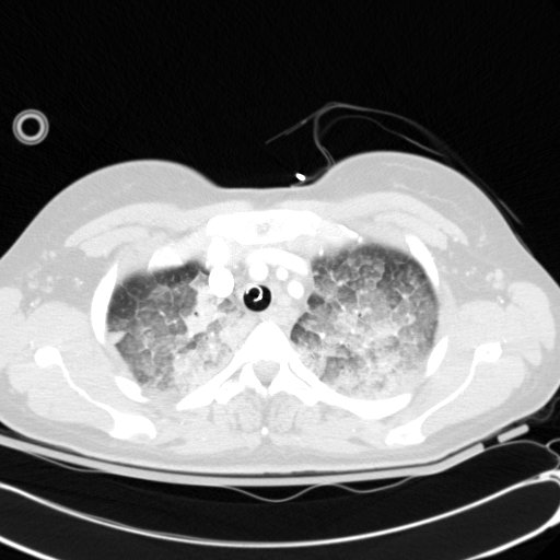 File:Acute myocardial infarction in CT (Radiopaedia 39947-42415 Axial lung window 24).jpg