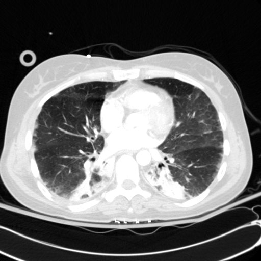 Acute myocardial infarction in CT (Radiopaedia 39947-42415 Axial lung window 76).jpg
