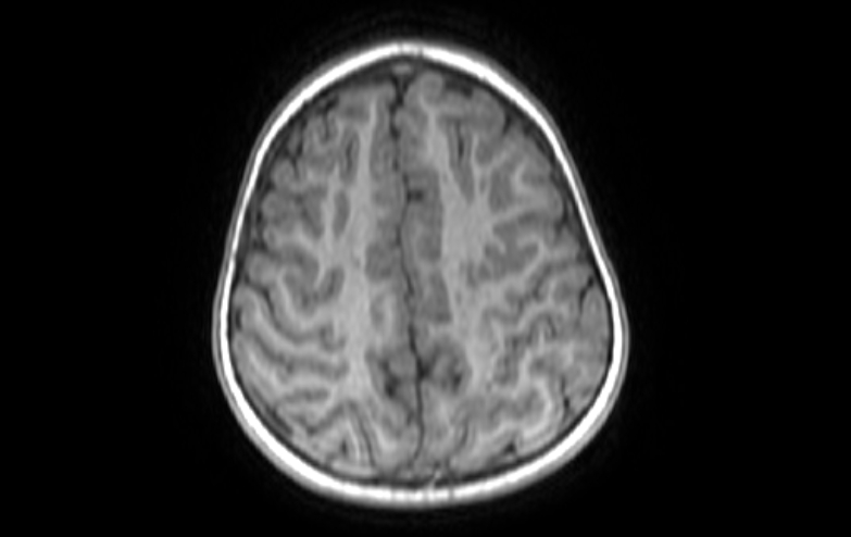 Acute necrotizing encephalitis of childhood (Radiopaedia 67356-76737 Axial T1 20).jpg