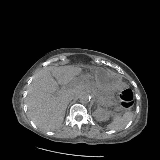 Acute on chronic pancreatitis (Radiopaedia 13233-13244 Axial non-contrast 16).jpg