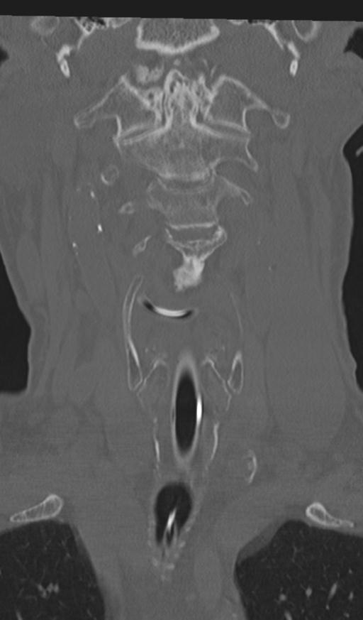 Acute on chronic subdural hematoma and thoracic vertebral injury in a multitrauma patient (Radiopaedia 31698-32619 Coronal bone window 13).jpg