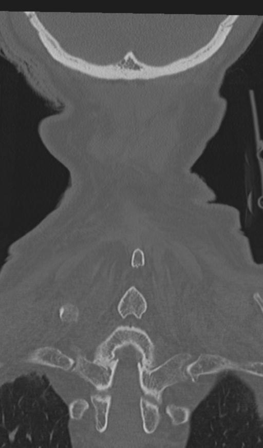 Acute on chronic subdural hematoma and thoracic vertebral injury in a multitrauma patient (Radiopaedia 31698-32619 Coronal bone window 61).jpg