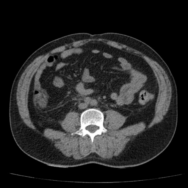 Acute pancreatitis (Radiopaedia 26663-26813 Axial non-contrast 62).jpg
