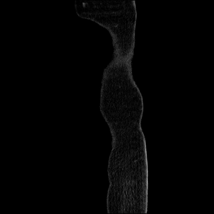 Acute pancreatitis (Radiopaedia 69236-79012 Sagittal C+ portal venous phase 96).jpg
