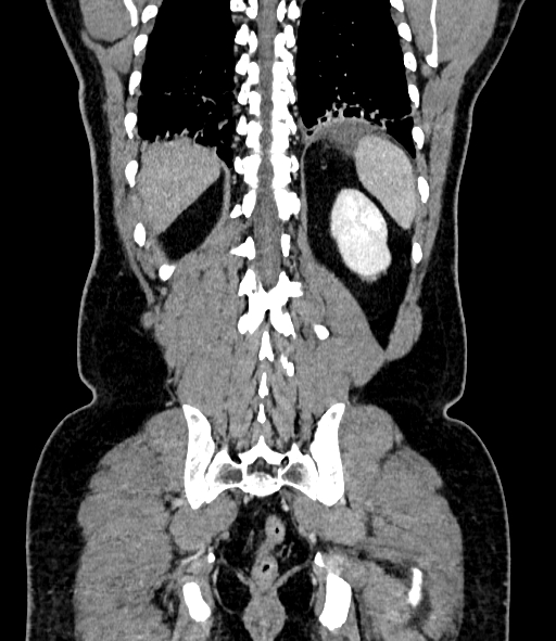 File:Acute pancreatitis (Radiopaedia 87428-103757 Coronal C+ portal venous phase 74).jpg