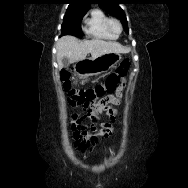 Acute pancreatitis - Balthazar C (Radiopaedia 26569-26714 Coronal C+ portal venous phase 20).jpg