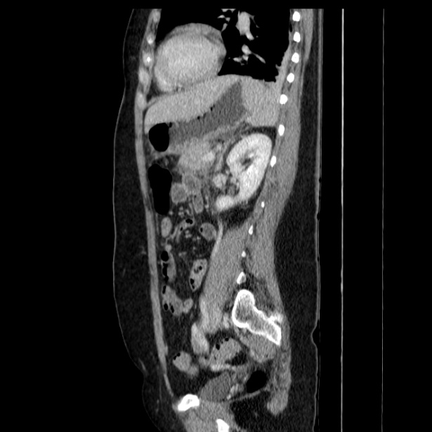 Acute pancreatitis - Balthazar C (Radiopaedia 26569-26714 Sagittal C+ portal venous phase 44).jpg
