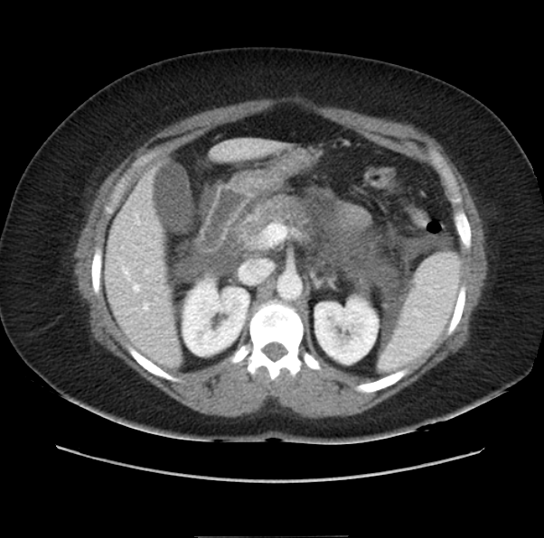 Acute pancreatitis - Balthazar E (Radiopaedia 29016-29377 Axial C+ portal venous phase 23).png