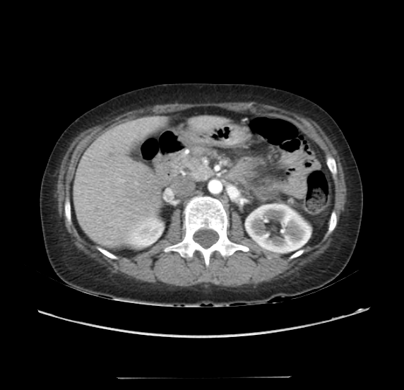 File:Acute pancreatitis - Balthazar E - post ERCP (Radiopaedia 27562-27772 Axial C+ arterial phase 21).png