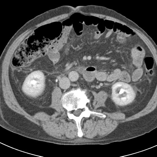Acute pancreatitis and walled-off necrosis (Radiopaedia 29888-30403 Axial C+ delayed 45).jpg