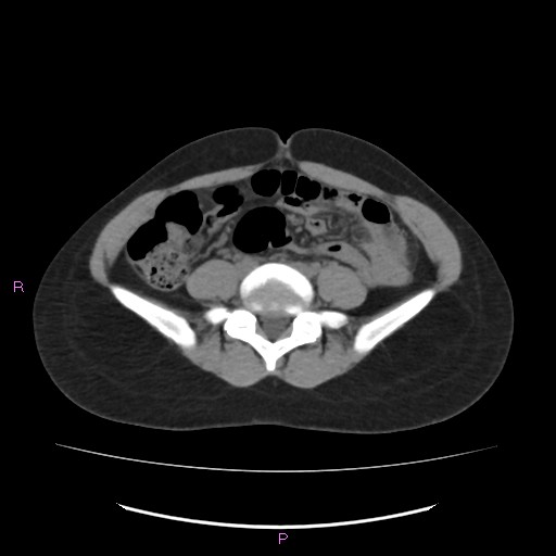 Acute pancreatitis secondary to stone at minor papilla and pancreatic divisum (Radiopaedia 76570-88333 Axial non-contrast 48).jpg