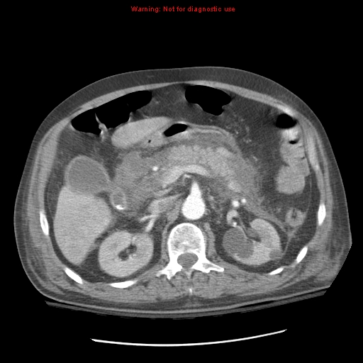 Acute pancreatitis with incidental pancreatic lipoma (Radiopaedia 10190-10730 Axial C+ arterial phase 38).jpg
