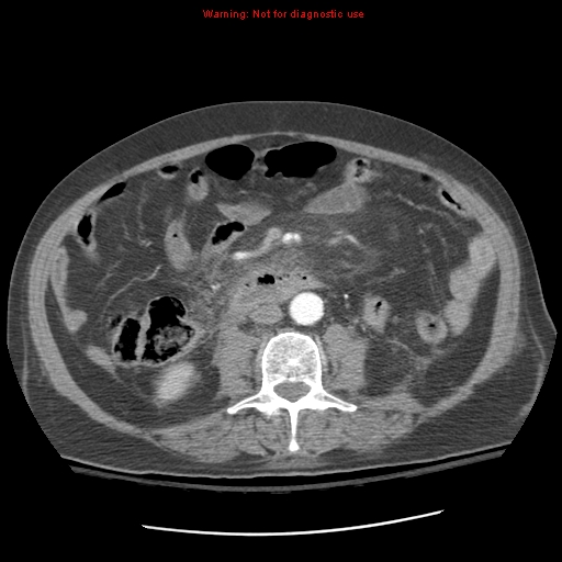 Acute pancreatitis with incidental pancreatic lipoma (Radiopaedia 10190-10730 Axial C+ arterial phase 57).jpg