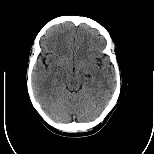 File:Acute pontine infarct from vertebral artery dissection (Radiopaedia 34111-35369 Axial non-contrast 11).png