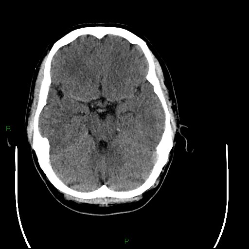 Acute posterior cerebral artery territory infarct (Radiopaedia 79329-92393 Axial non-contrast 38).jpg