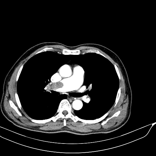 File:Acute pulmonary embolism (Radiopaedia 69510-79390 D 6).jpg